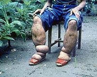 'Elephantiasis' virus may boost AIDS risk: study