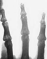 Nanotubes Inspire New Technique For Healing Broken Bones
