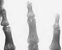 Nanowire Coating For Bone Implants And Stents