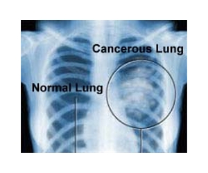 Advances in personalized medicine for lung cancer