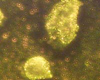 Gold Nanoparticles May Simplify Cancer Detection