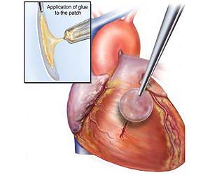 Bio-inspired glue keeps hearts securely sealed
