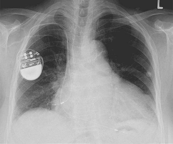 Researchers present battery-free pacemaker powered by the heart