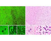 Shining light on brain tumors