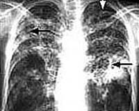 Extend TB Tests To More Foreign-Born Residents And Citizens